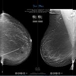 Breast cancer: In-bra ultrasound scanner to improve early detection •