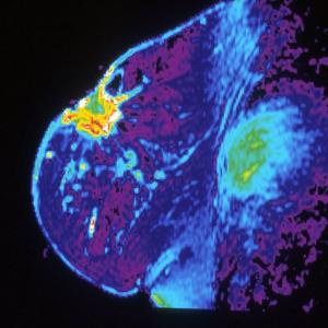 Breast cancer: hidden diagnostic information in surrounding tissue ...
