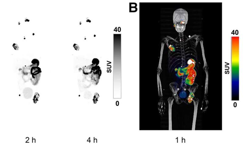GLP-1 agonists may interfere with cancer imaging, new study finds ...