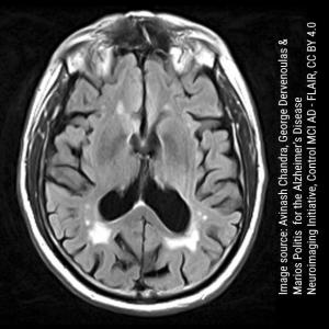 Alzheimer's: Researchers explore the dark side of the aging brain ...