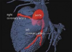 Fig 1. Coronary magnetic resonance angiography (MRA) visualising the left...