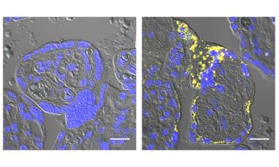 Researchers link Alzheimer’s disease protein to preeclampsia