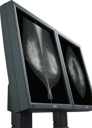 Photo: Two mammograms on one screen