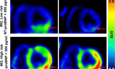 New Therapy May Reduce Heart Failure Risk After Heart Attack