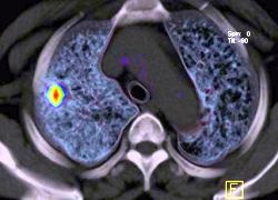 Malignant nodule in the right lung
©Siemens Medical Solutions