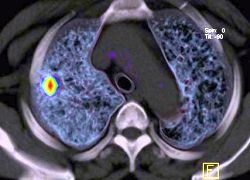 How Accurate Is a CT Scan for Lung Cancer?