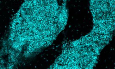 New ‘Immune Organ’ Found in Skull Could Help Fight Brain Cancer