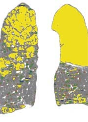 Quantitative CT and cluster analysis of emphysema with left upper lobe...