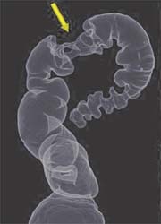 Photo: Clinical trial validates CT virtual colonoscopy