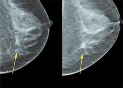 Breast Tomosynthesis