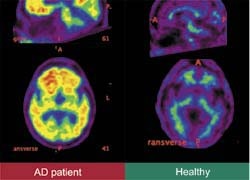 Photo: A novel PET tracer for early detection of Alzheimers