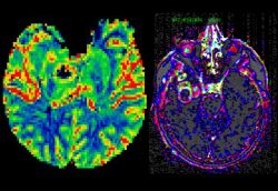 Fig. 1. DSC (left) and DCE (right) MRI presenting the heterogeneity of...