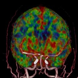 Neuro ONE Fusion
In a single 50cc contrast injection, a fused neuro CTA and...