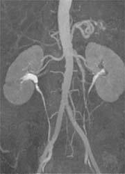Contrast-enhanced MR angiography of the abdomen (3T) after bolus injection of...