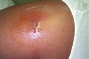 The abscess was caused by MRSA bacteria.