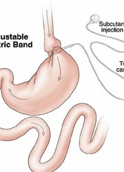 Fig. 1  Adjustable gastric banding: restricting stomach volume (food...
