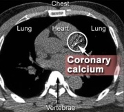 Photo: Arterieal calcium scan predicts death risk