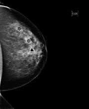 Photo: Young woman underrepresented in breast cancer studies