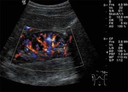 Ultrasound of a normal kidney (the intravascular blood flow, as measured...