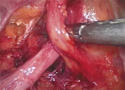 Laparoscopic urology surgery