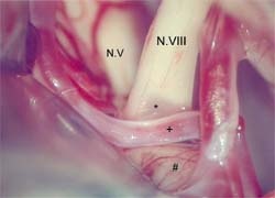 Compressed cranial nerve as the cause of vertigo: In disabling positional...