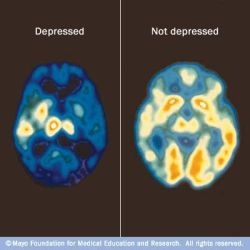 PET scan of brain for depression 