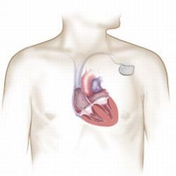 Cardiac resynchronisation therapy is delivered using a specialised device that...