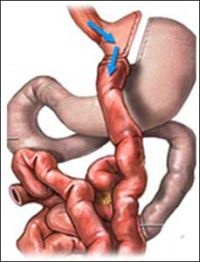 The Roux-en-Y Gastric Bypass Surgery bypasses part ot the small intestine...
