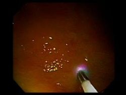 Endoscopic view remains available while imaging with the confocal microprobe.
