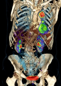 Whole body PET-Scan within five minutes with mCT by Siemens Healthcare