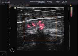 Photo: Elastoscan in mammary sonography