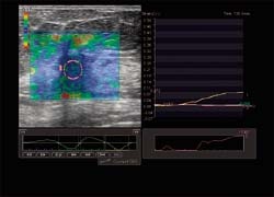 Fig. 2: Elastography shows marked stiffness in a cancer with a high fat to...