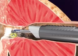 Fig. 2: The plasma vaporisation electrode vaporises the tissue fast and...