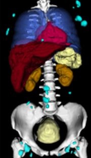 Automatic detection of lymph nodes in a CT chest and abdomen scan