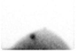 Image taken using breast-specific gamma imaging (BSGI).
