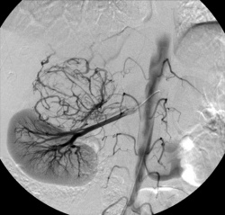 Arterial filling of Right Renal Artery with abnormal vascular filling above...