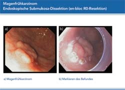 ESD (en bloc R0 resection): Early stomach carcinoma; marking of lesion