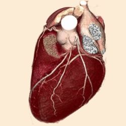 3D volume heart acquired with Toshibas Aquilion ONE CT within one heart beat.
