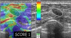 Photo: Realtime-Sonoelastography to detect and characterize breast lesions