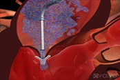 Photo: Non surgical mitral valve repair: First enrollment in ACCESS-Europe study
