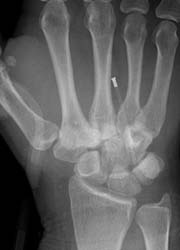 X-ray of a carpometacarpal dislocation
