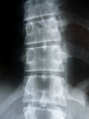 Photo: Rückenschmerzen mit minimal-invasiven Therapien behandeln