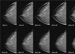 Fig.1:  3-D digital mammography, tomosynthesis (Selenia by Lorad)