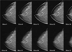 Digital Mammography- Is Mammography Safe | What happens during mammography | Digital mammography