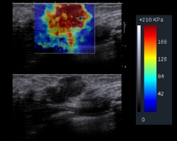 This image, obtained by SuperSonic Imagines Aixplorer Ultrasound System using...