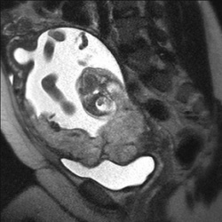 An MRI image showing that the placenta overlies the cervix, but has an...