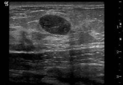 A breast ultrasound image showing a benign mas