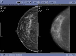 Photo: How do you improve mammogram accuracy? Add noise