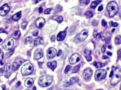 Pathological white blood cells (B cells) in a diffuse large B cell lymphoma; in...