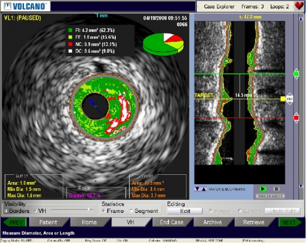Intravenous ultrasound (IVUS) with VH (Virtual
Histology)
